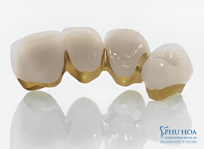 Răng sứ kim loại quý có tính thẩm mỹ và độ bền cao