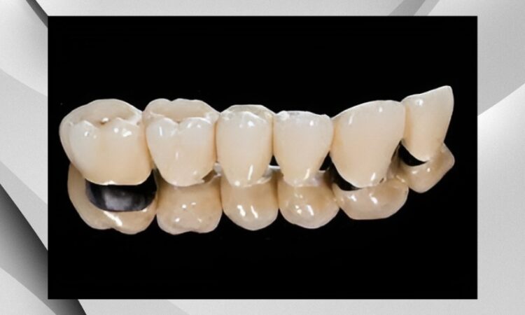 Răng sứ Titan với tính thẩm mỹ và độ bền cao