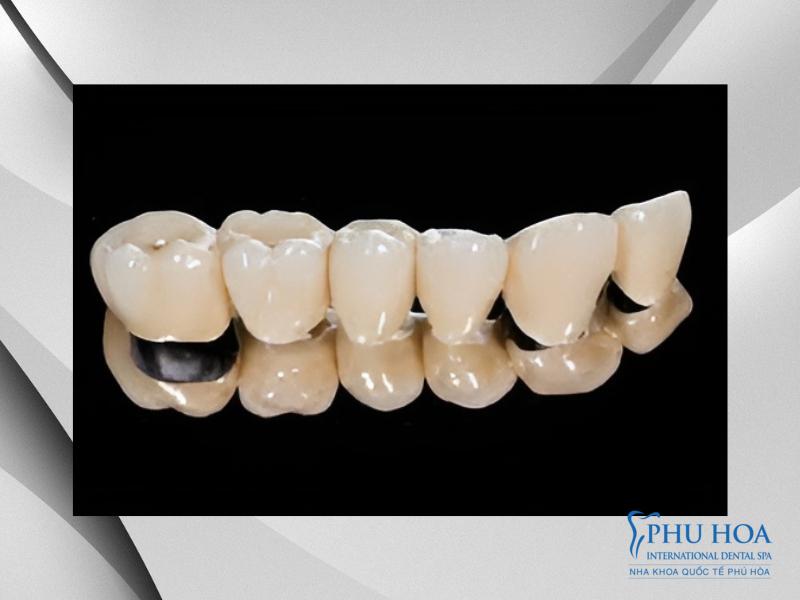 Răng sứ Titan có tính thẩm mỹ cao và khả năng chống oxi hóa