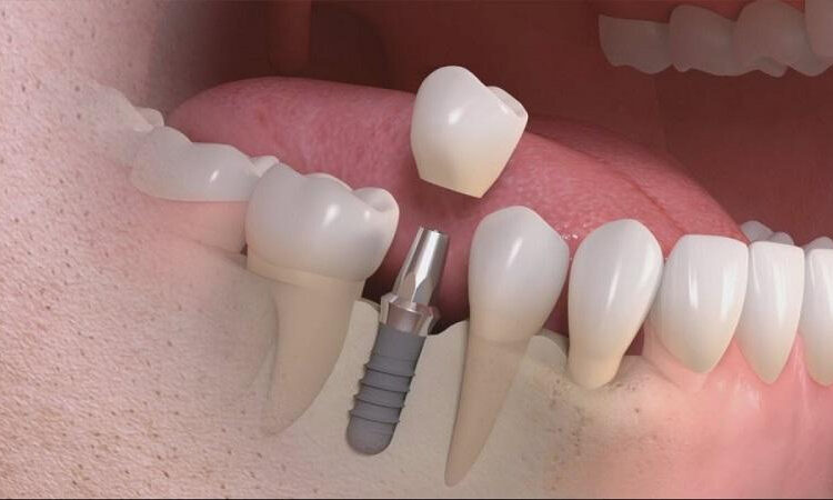 Những trường hợp được chỉ định cần làm răng tạm trên Implant