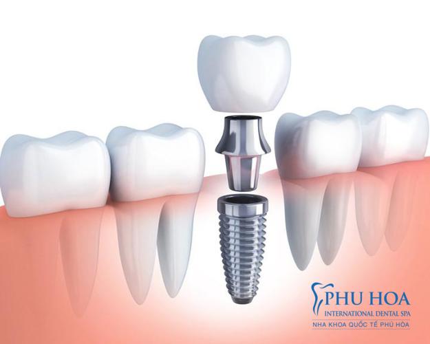Quy trình thực hiện gắn răng tạm trên Implant