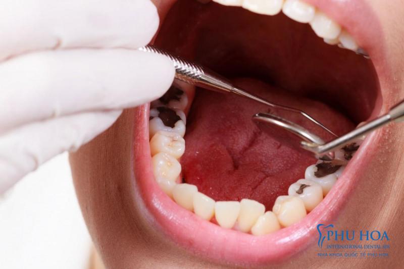 Các bệnh về nha chu sẽ khiến răng bị đau nhức