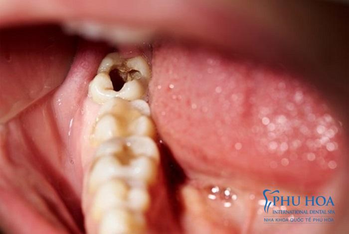 Người đang bị nhiễm trùng nặng thì không nên nhổ răng đau