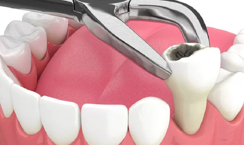 6 trường hợp bắt buộc phải tiến hành nhổ răng