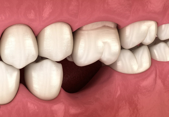 Nhổ răng mà không trồng lại gây ra tình trạng tiêu xương hàm, lão hóa sớm