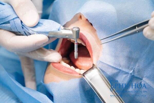 Trồng răng implant để ngăn chặn tiêu xương hàm