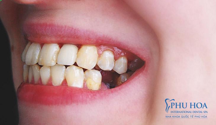 Nhổ răng không trồng lại gây ảnh hưởng đến quá trình ăn nhai
