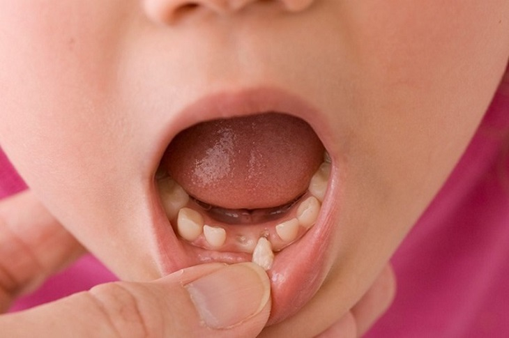 Dấu hiệu nhận biết tình trạng nhổ răng sữa còn sót chân răng ở trẻ
