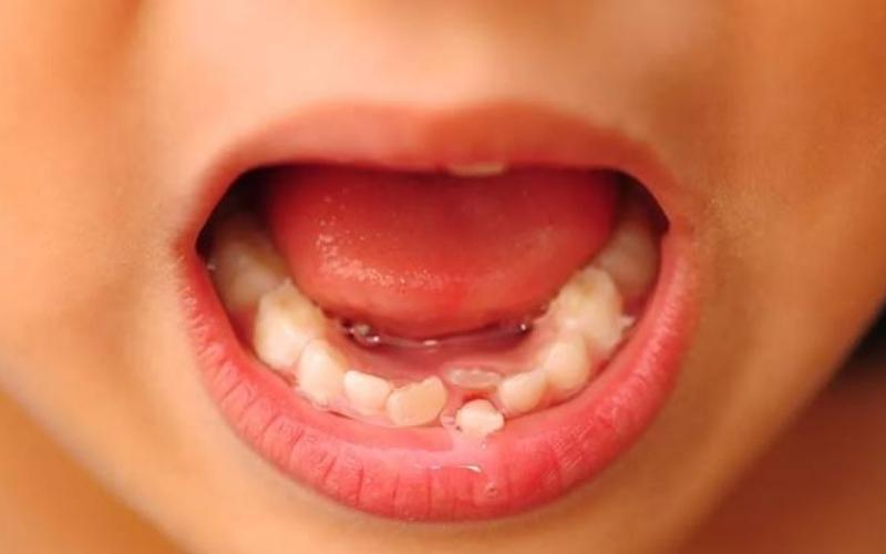 4 Nguy cơ gặp phải khi răng sữa chưa nhổ mà đã mọc răng mới vĩnh viễn