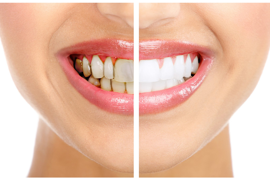 Nha khoa Quốc Tế Phú Hòa – Địa chỉ tẩy trắng răng không đau 1 dia-chi-tay-trang-rang-khong-dau